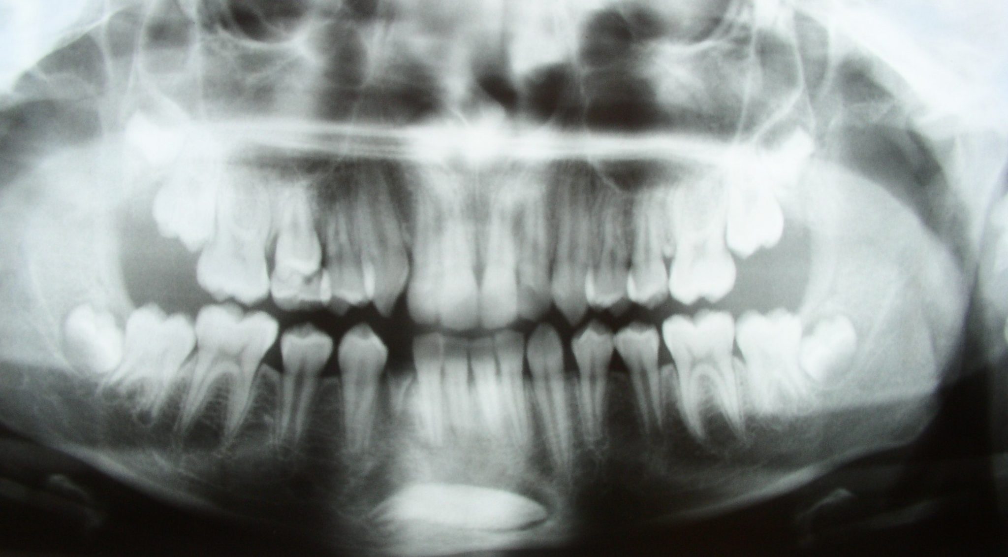 Cirugía Oral, Bucal Y Maxilofacial En Bilbao | Clínica Dental Euskalduna