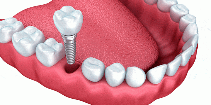 implantes-dentales