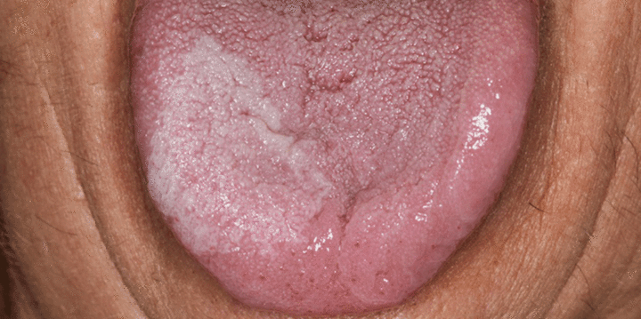 lesion-blanca-lengua